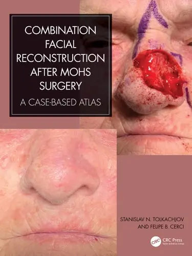 Combination Facial Reconstruction After Mohs Surgery A Case Based Atlas by Stanislav N. Tolkachjov 978-0367903183