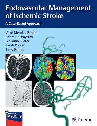 Endovascular Management of Ischemic Stroke A Case-Based Approach by Vitor Pereira ISBN: 978-1626232754